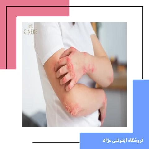 چطور خارش والتهاب پوست ناشی از الرژی را مهار کنیم ؟